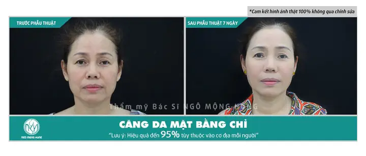 Căng Da Chỉ Vàng Giá Bao Nhiêu