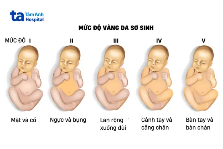 Nguyên Tắc Karmer Đánh Giá Vàng Da Sơ Sinh