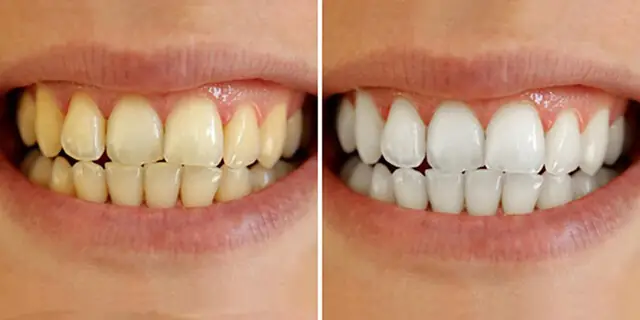 Tẩy Răng Ố Vàng Giá Bao Nhiêu