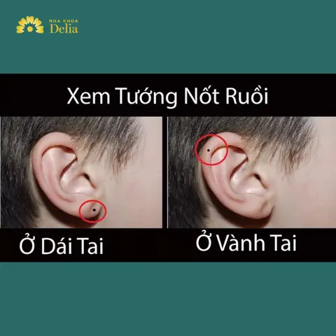 Baấm Lỗ Tai Phong Thủy Để Làm Ăn